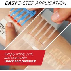 Clozex Dispositivo de cierre de heridas: reparación de 3 laceraciones individuales de 3 3/8 pulgadas sin puntadas